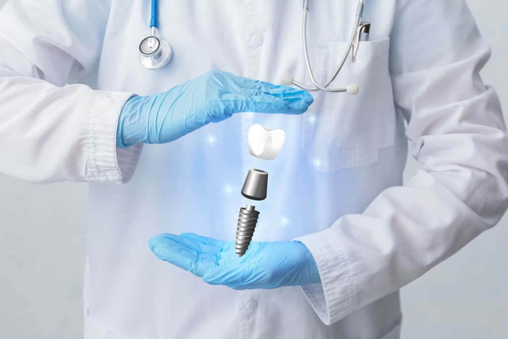 Dental Implants